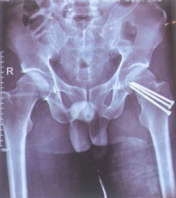 X-quang sau mổ kết hợp xương vít xốp cổ xương đùi trái