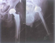 X-quang sau mổ thay khớp háng (T) bán phần