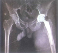 X-quang sau mổ thay khớp háng (T) toàn phần