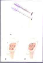 Các cách bắt vít xốp