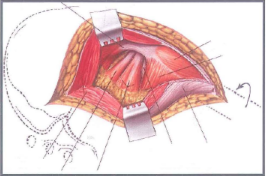 Khớp háng sau khi vén cơ mông nhỡ