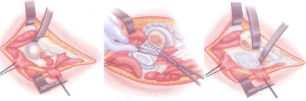 Bộc lộ và cắt cổ xương đùi