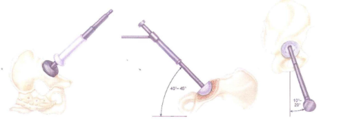 Tư thế roa ổ cối và thử ổ cối