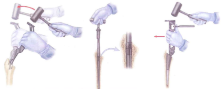 Tư thế ráp và roa ống tủy xương đùi