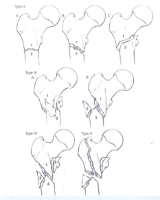 Phân loại gãy DMC Seinsheimer