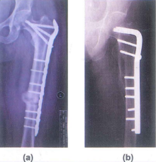 Nẹp đầu trên xương đùi với gãy phức tạp