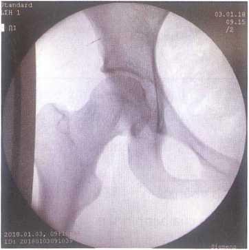 Kểm tra trên C.arm sau nắn trật khớp háng
