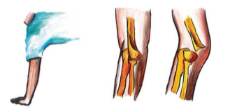 Cơ chế gãy duỗi trong gãy trên lồi cầu xương cánh tay trẻ em