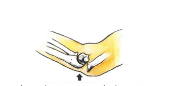 Cơ chế gãy gấp trong gãy trên lồi cầu xương cánh tay