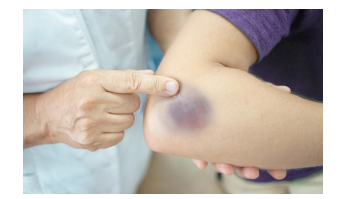 Dấu hiệu bầm tím Kirmisson