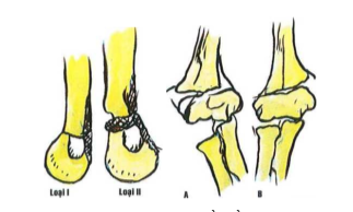 Phân loại gãy trên lồi cầu xương cánh tay theo Gartland và Gartland cải biên