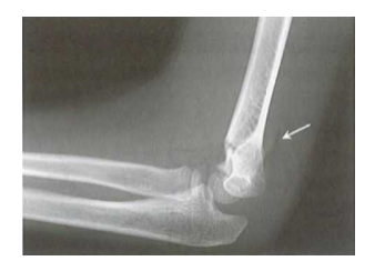 Dấu hiệu mỡ phía sau trong gãy trên lồi cầu xương cánh tay Gartland I