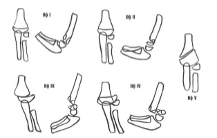 Phân loại gãy trên lồi cầu xương cánh tay trẻ em theo Lagrange and Rigault
