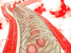 Nguy cơ chảy máu sau đặt stent mạch vành