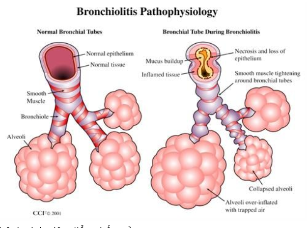 Cơ chế bệnh sinh viêm tiểu phế quản
