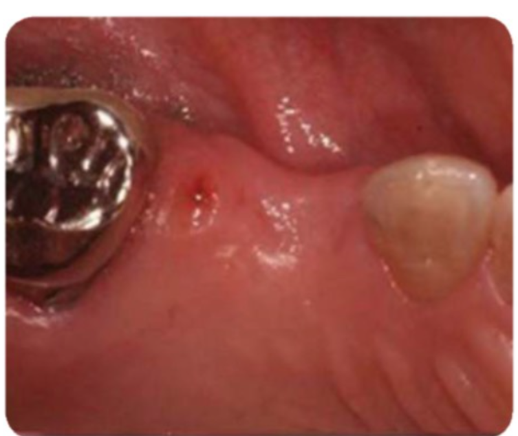 Tình trạng sau khi tháo nhịp cầu (mặt nhai)