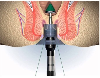 Minh họa điều trị bệnh trĩ bằng phương pháp ngoại khoa