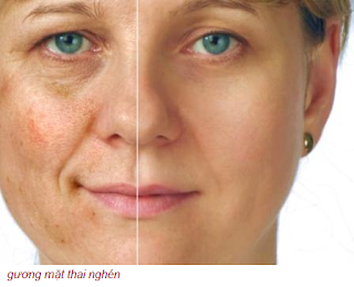 Gương mặt thai nghén