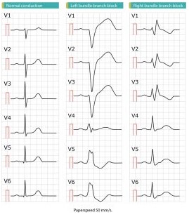 LBBB và RBBB
