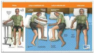 Các tư thế nằm cho bệnh nhân liệt nửa người