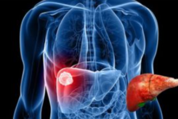 Tầm soát ung thư tế bào gan vô cùng quan trọng ở nhóm người có nguy cơ cao