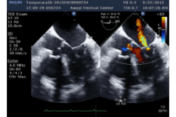 Siêu âm tim qua thực quản hở van hai lá