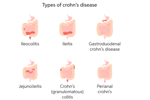 Minh họa đánh giá bệnh Crohn