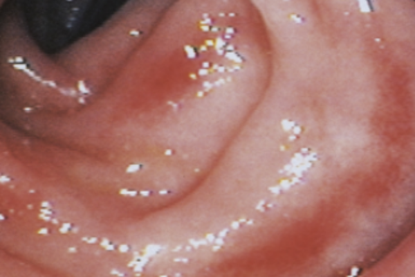 Hình ảnh viêm loét đại tràng trên nội soi