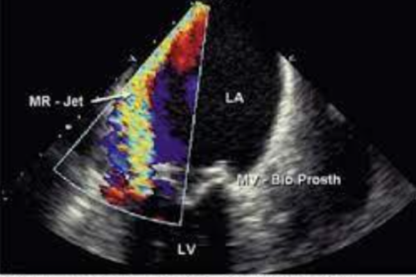 Siêu âm tim qua thực quản trong van tim nhân tạo