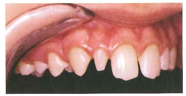 Răng cửa bên dạng trụ.