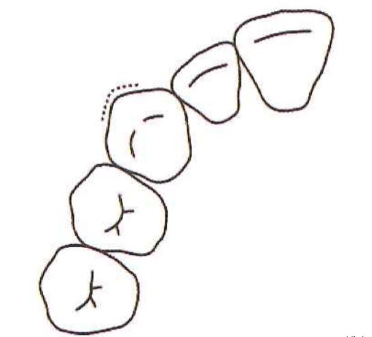 Mặt ngoài răng nanh gỗ nhiều.