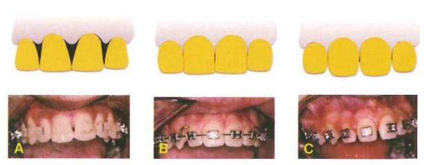 Các loại hình dạng răng cửa. A, Răng dạng tam giác. B, Răng dạng chữ nhật. C, Răng dạng quả trứng.