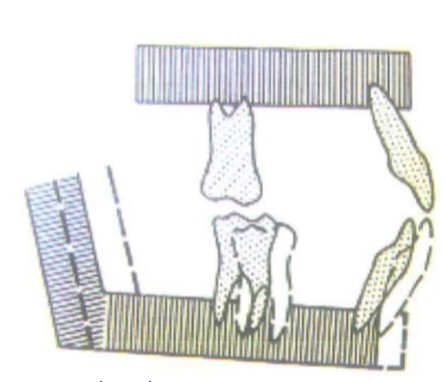 độ mở khớp cắn