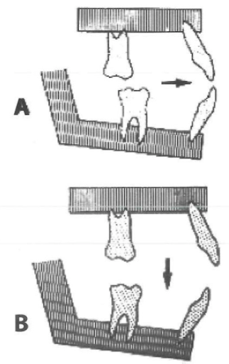 khớp cắn trong chỉnh nha