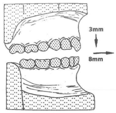 Khớp cắn được thiết lập với độ mở hàm ít và răng cửa đối đầu.