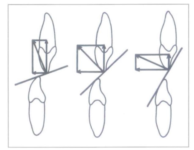 Lực tác động lên răng khi khí cụ mang mặt phẳng nghiêng