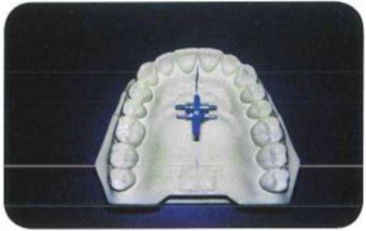 Vẽ đường phân chia nền hàm