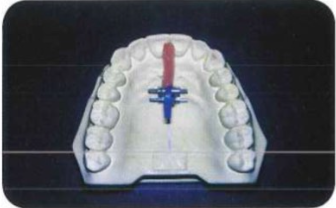 Đắp sáp theo đường phân chia nền hàm.