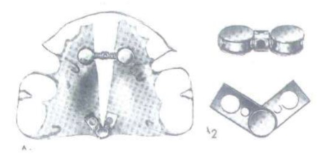 Ốc nới rộng dạng rẻ quạt dùng cho hàm trên. Ốc gồm hai phần: một trục bản lề và một ốc xoay.