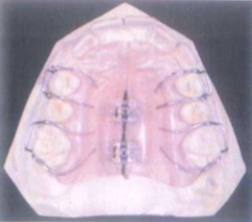 Khí cụ tách nền của Martin Schwartz, Áo.