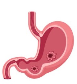 Chảy máu ổ loét dạ dày