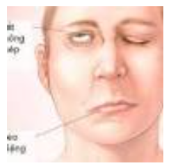 Hướng dẫn chăm sóc mắt ở người bệnh liệt VII ngoại biên