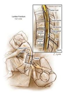 Ảnh minh họa chọc dò dịch não tủy
