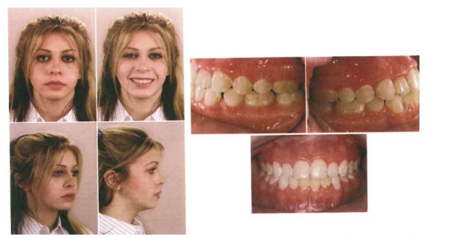 Bệnh nhân đã được chỉnh nha lại, khớp cắn không đạt tiêu chuẩn như đã chỉnh trước, nhưng giải quyết được thẩm mỹ dạng mặt nhìn nghiêng (nguồn: Graber: Orthodontics: Principle and Technique, 2017).