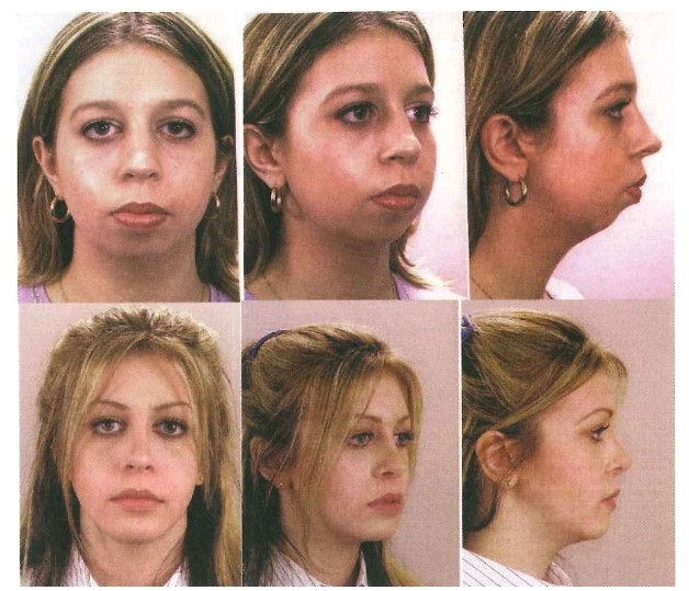 So sánh kết quả giữa hai quan điểm điều trị hướng mô cứng và hướng mô mềm về phương diện thẩm mỹ mặt (nguồn: Graber: Orthodontics: Principle and Technique, 2017).