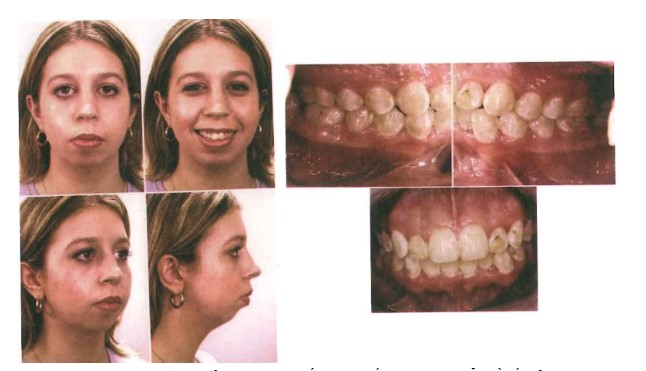 Bệnh nhân đã được chỉnh nha hoàn tất, khớp cắn đạt tiêu chuẩn về tất cả các tương quan đường giữa, tương quan lồng múi và hạng I răng cối, răng nanh, nhưng không giải quyết được thẩm mỹ dạng mặt nhìn nghiêng (nguồn: Graber: Orthodontics: Principle and Technique, 2017).