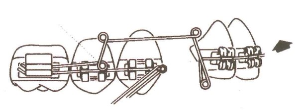 Nguyên tắc phân đoạn và bẻ cung tiện ích trong điều trị chỉnh nha.