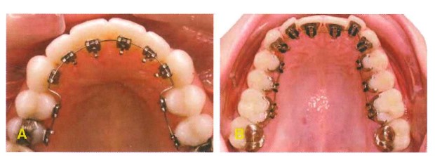 Mắc cài mặt lưỡi. A, Mắc cài mặt lưỡi làm sẵn và gắn với kỹ thuật gián tiếp. B, Mắc cài mặt lưỡi Incognito, chế tác với công nghệ CAD/CAM.