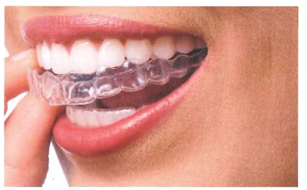 Chỉnh nha với kỹ thuật sử dụng mảng trong (Invisalign).