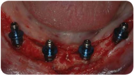 Đặt implant ở cung hàm dưới